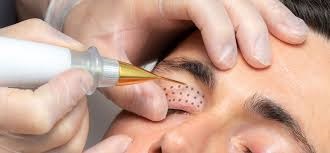 Blepharoplasty Treatment