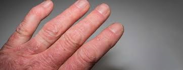 Psoriatic Arthritis Drugs